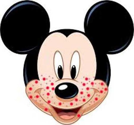 Measles 