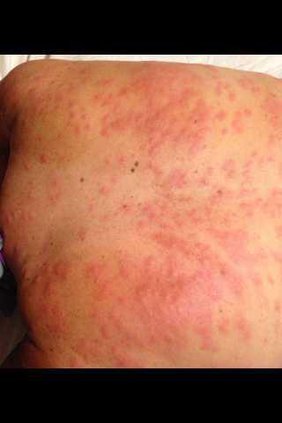 THURS-Mosquito-bites-2