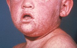 measles