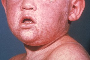 measles