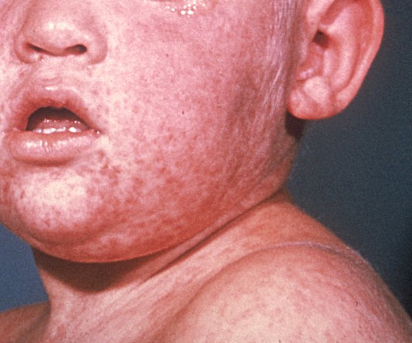 measles