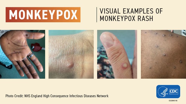 monkey pox graphic