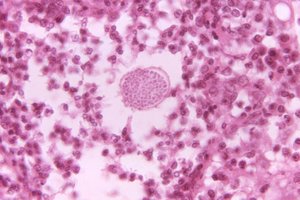 Valley Fever under microscope