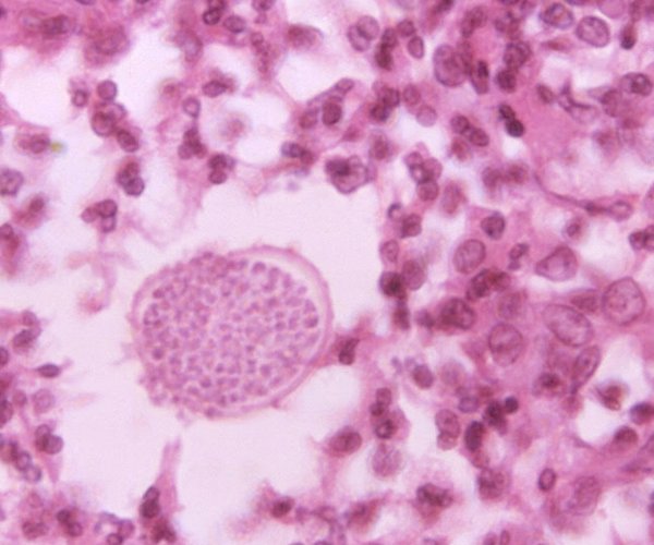 Valley Fever under microscope