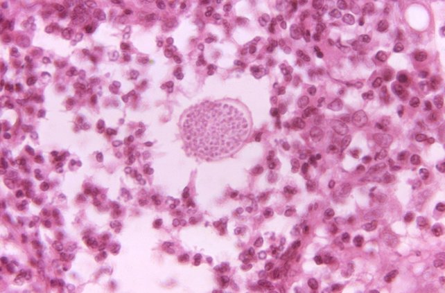 Valley Fever under microscope