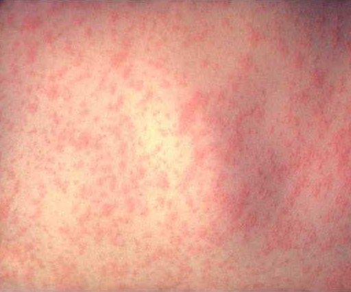 measles