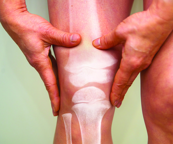 10-21 Osteoporosis